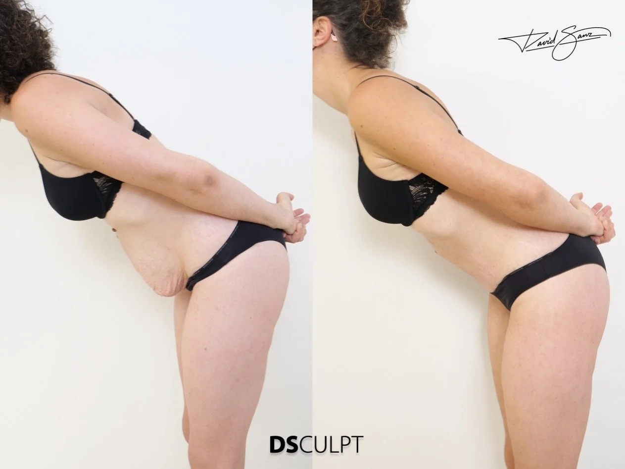diferencia entre diástasis de rectos y abdominoplastia abdominal