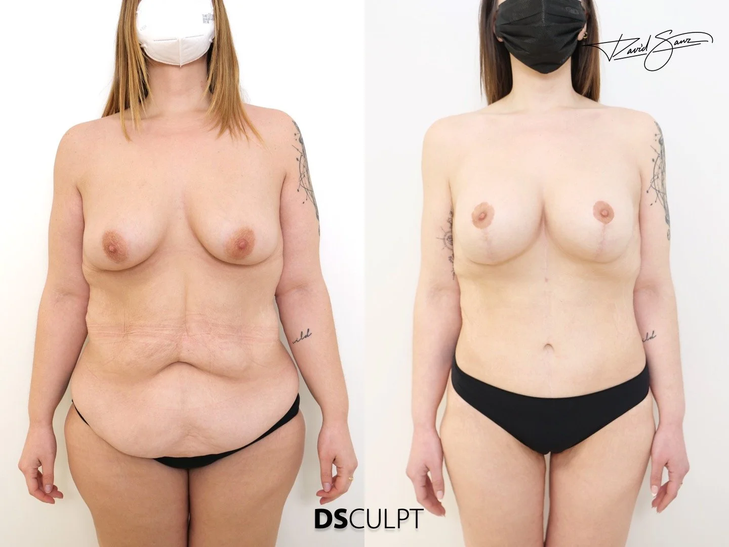 Planificación quirúrgica previa a reconstrucción abdominal