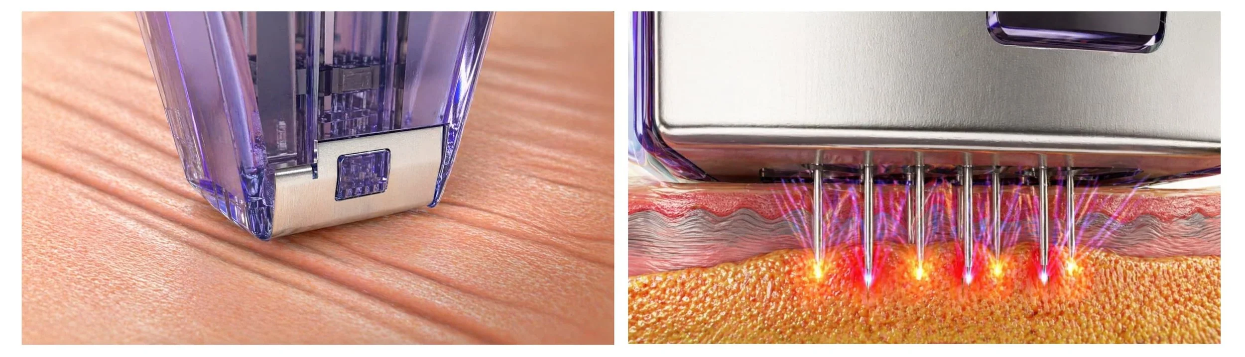 Radiofrecuencia fraccionada de Morpheus actuando sobre epidermis dermis y tejido subcutáneo