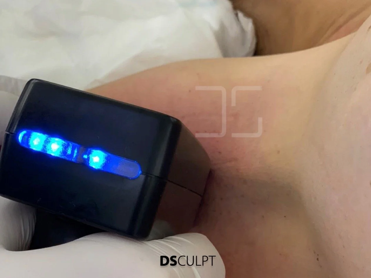 Precio y tratamiento Morpheus8 para hiperhidrosis en Barcelona con protocolo de tres sesiones para reducción del sudor excesivo en DSculpt Clinic