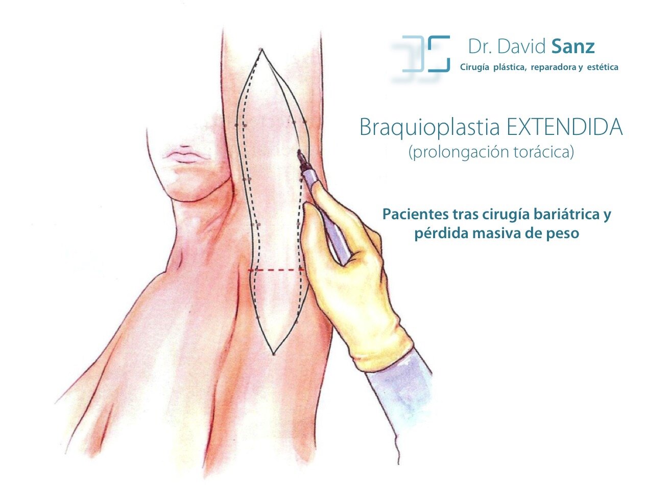 prolongación torácica braquioplastia.jpg