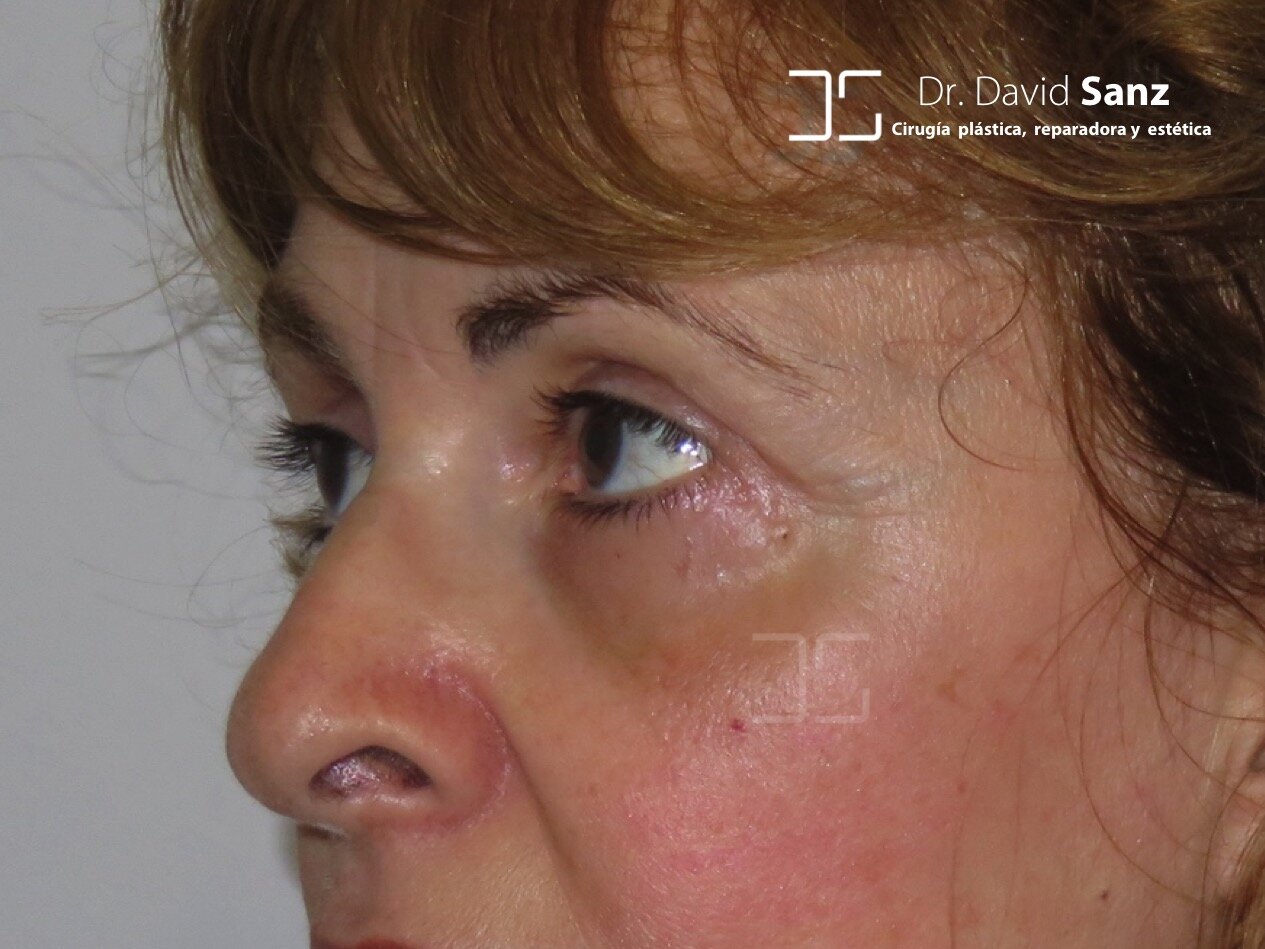 blefaroplastia barcelona 2.jpg