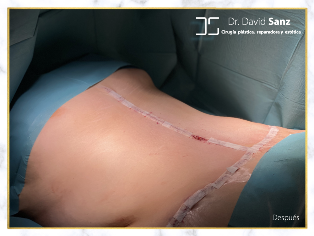 Abdominoplastia flor de lis — Dr. David SANZ