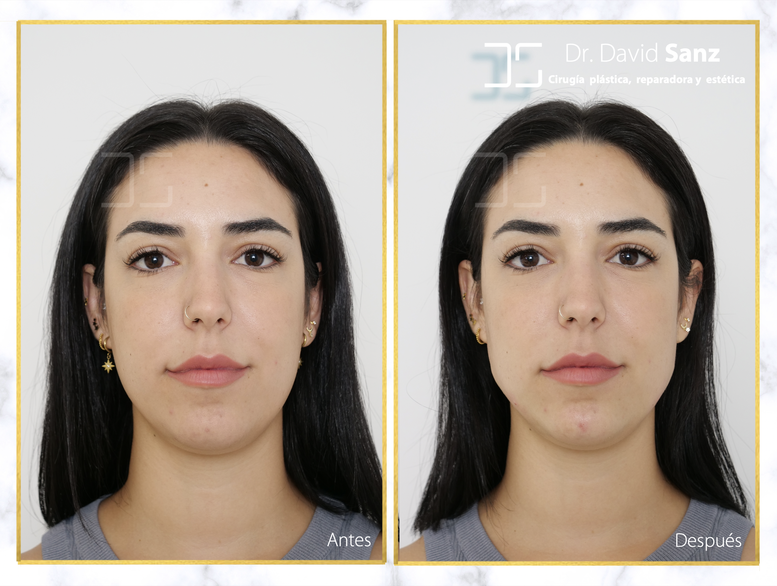 armonización facial en mujeres barcelona.png