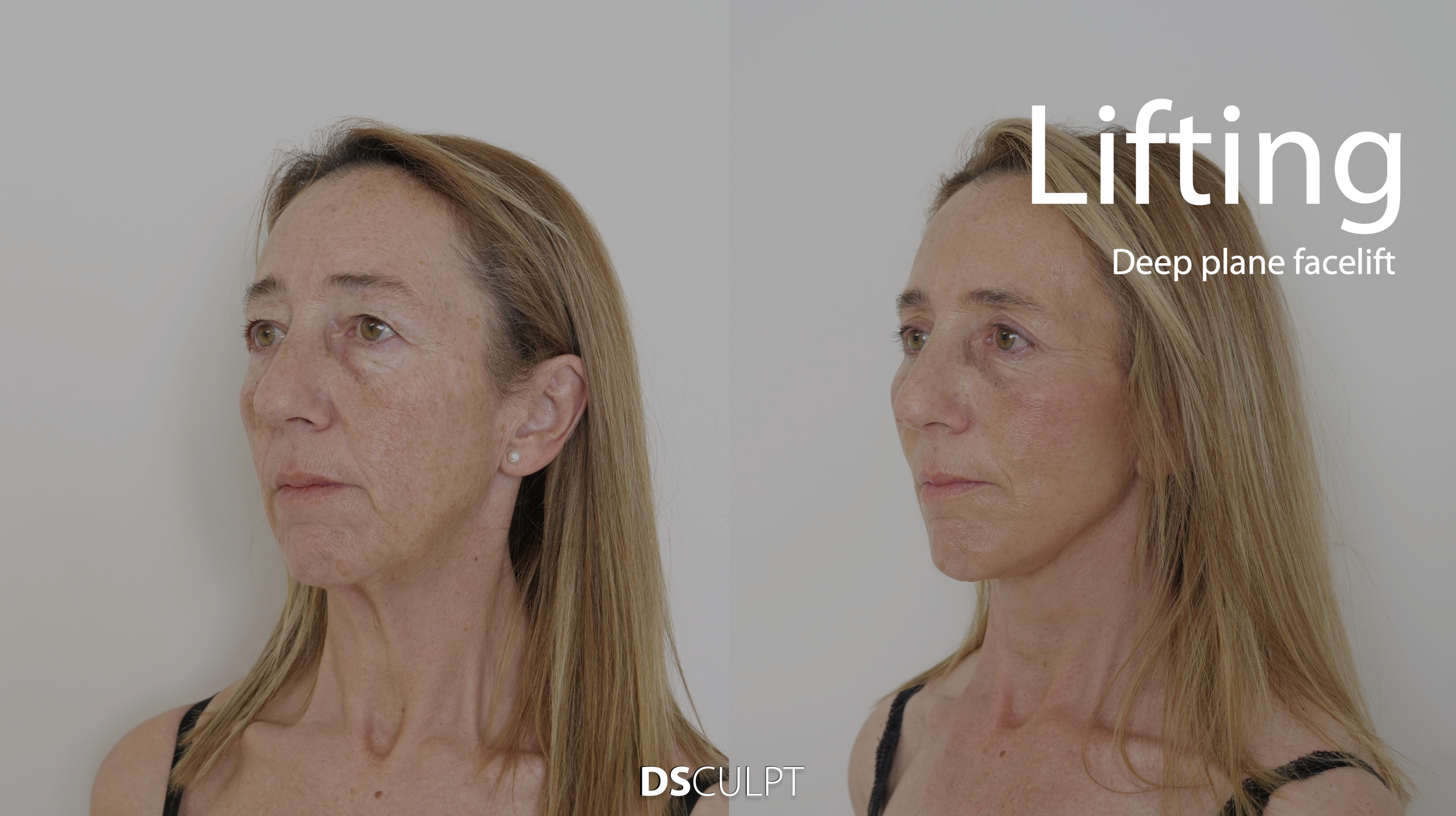deep plane facelift barcelona mejor clinica.png