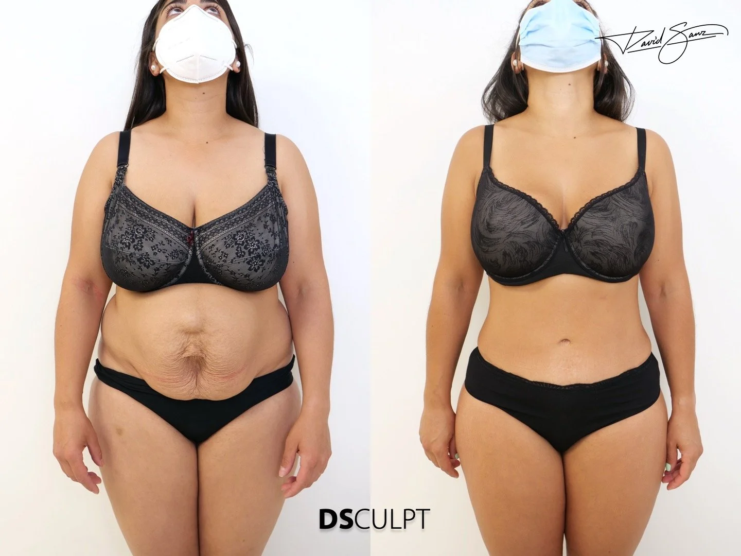 reparacion-hernia-umbilical-y-diastasis-barcelona.jpeg