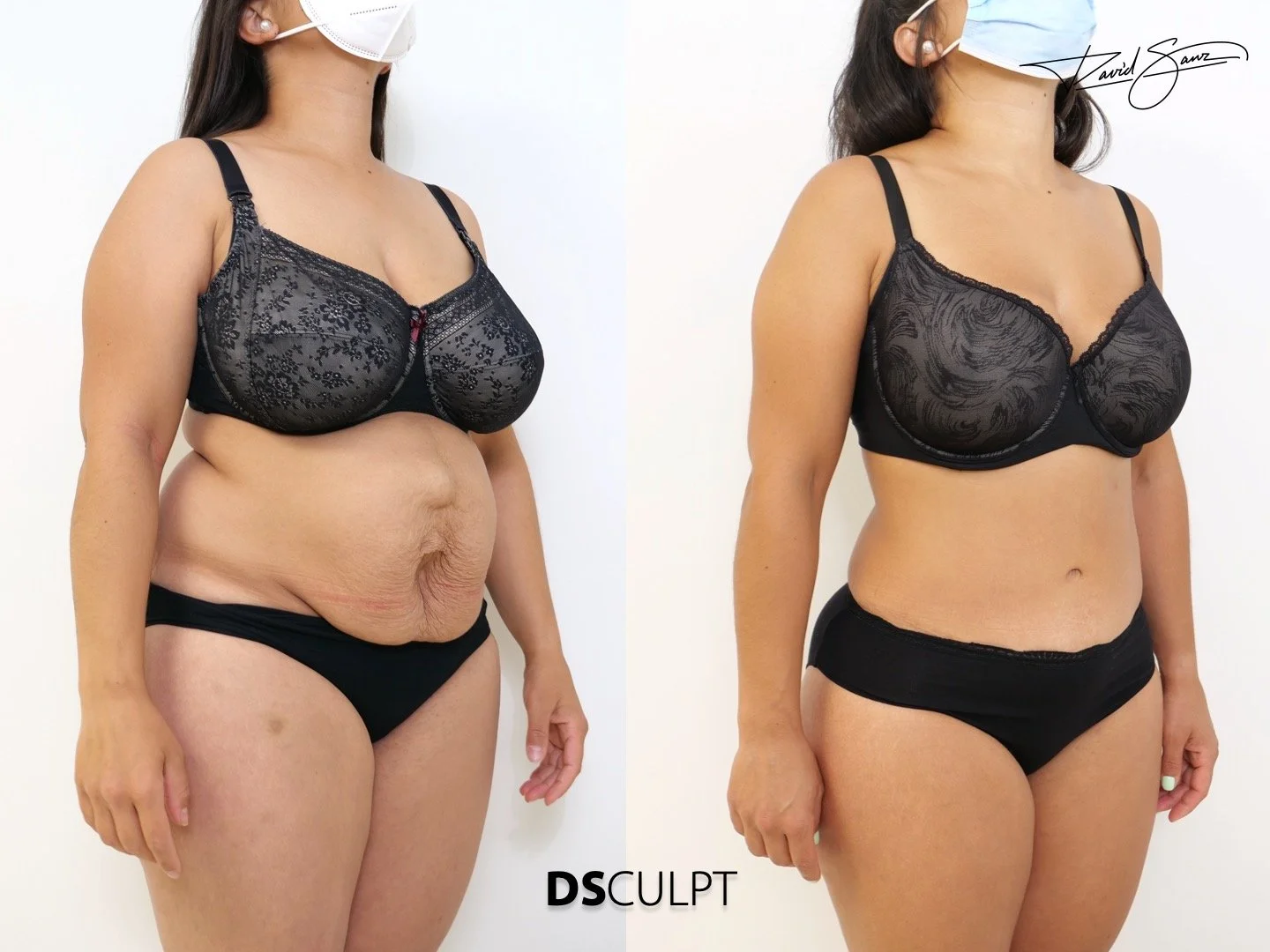 eventracion-abdominal-cirugia-reconstructiva.jpeg