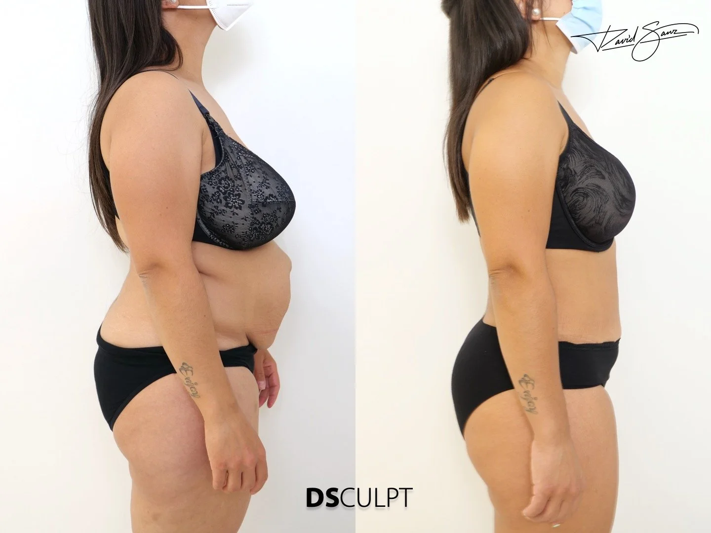 abdominoplastia-avanzada-con-reparacion-muscular.jpeg