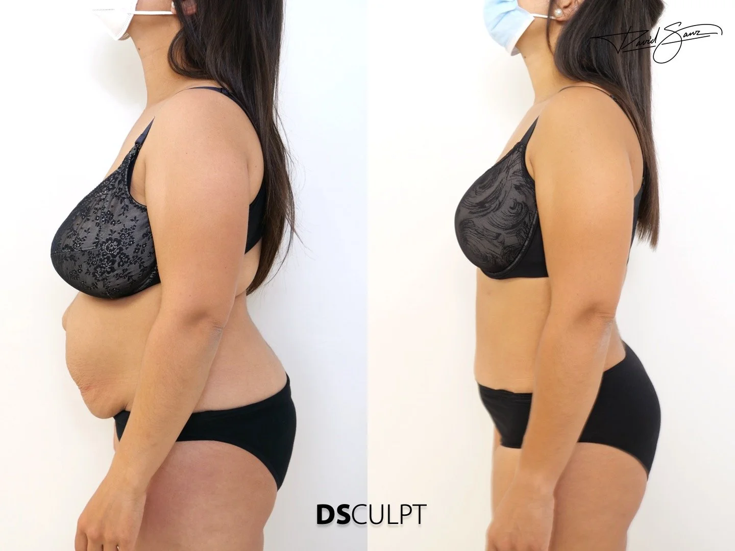 antes-despues-reparacion-abdominal-barcelona.jpeg