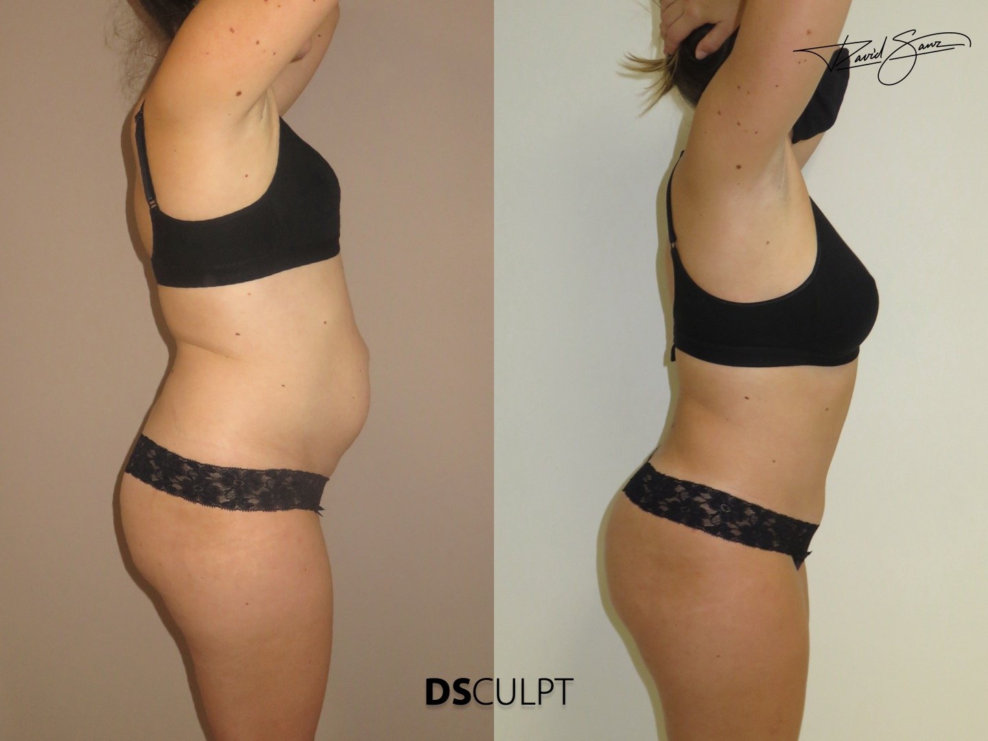 cirugia-reconstruccion-pared-abdominal-barcelona.jpeg