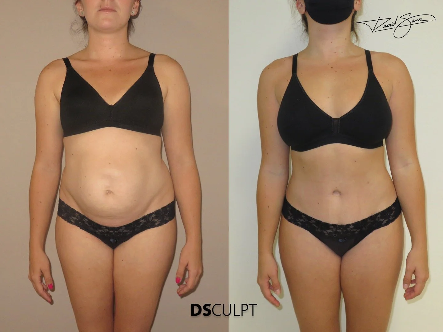 reconstruccion-abdominal-barcelona-dr-david-sanz.jpeg