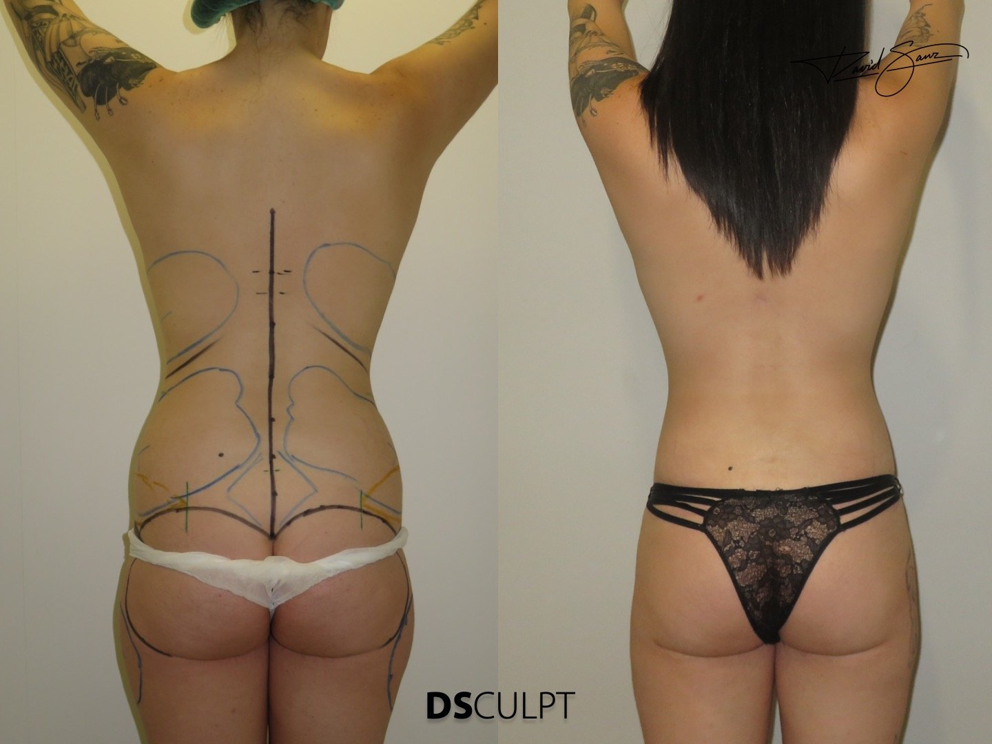 abdominoplastia-circular-resultado-natural-barcelona.jpeg