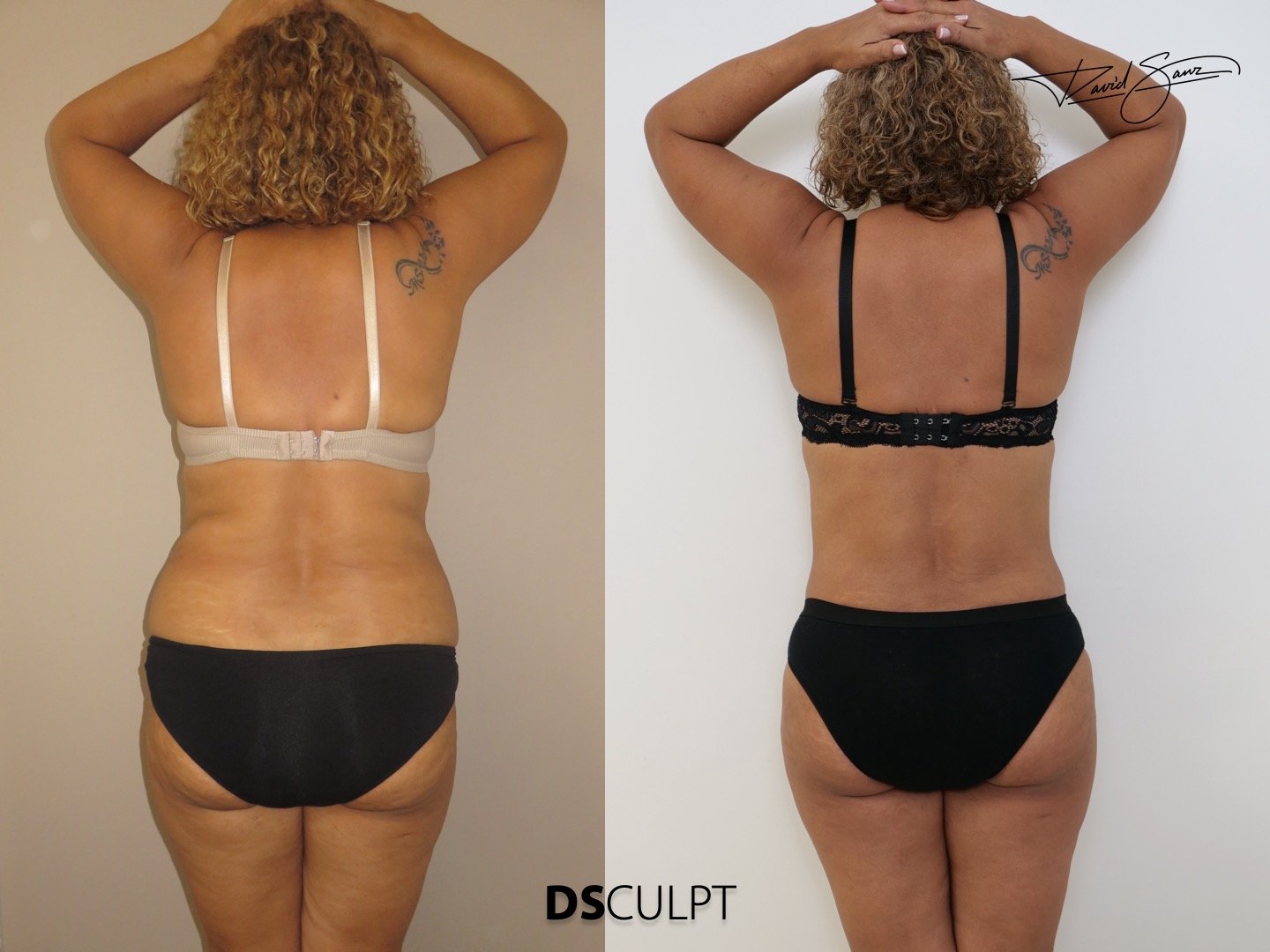 lower-body-lift-resultado-armonico-barcelona.jpeg