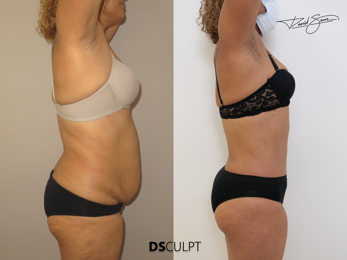 abdominoplastia-360-postbariatrica-barcelona.jpeg