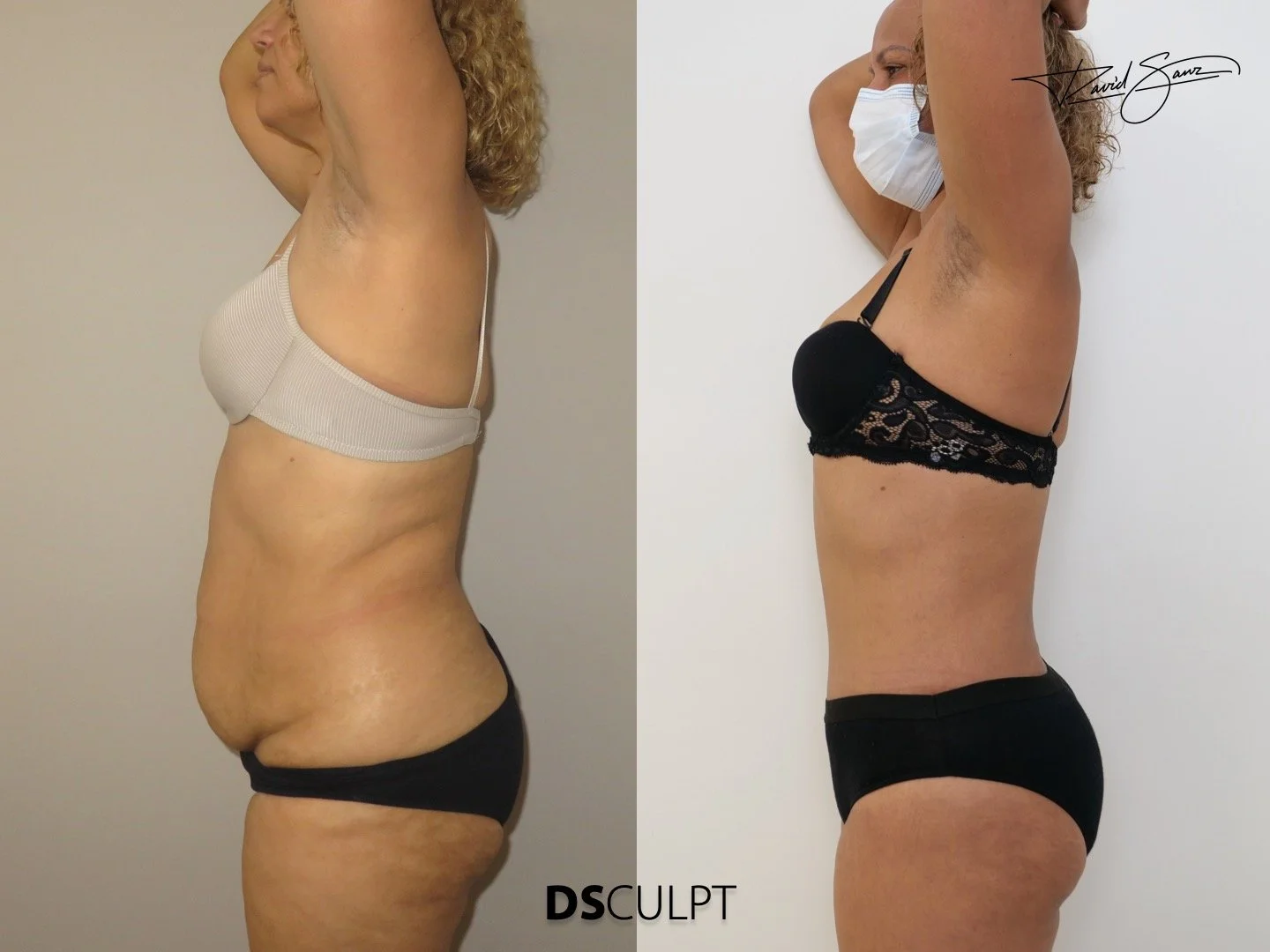 abdominoplastia-circular-seguridad-barcelona.jpeg