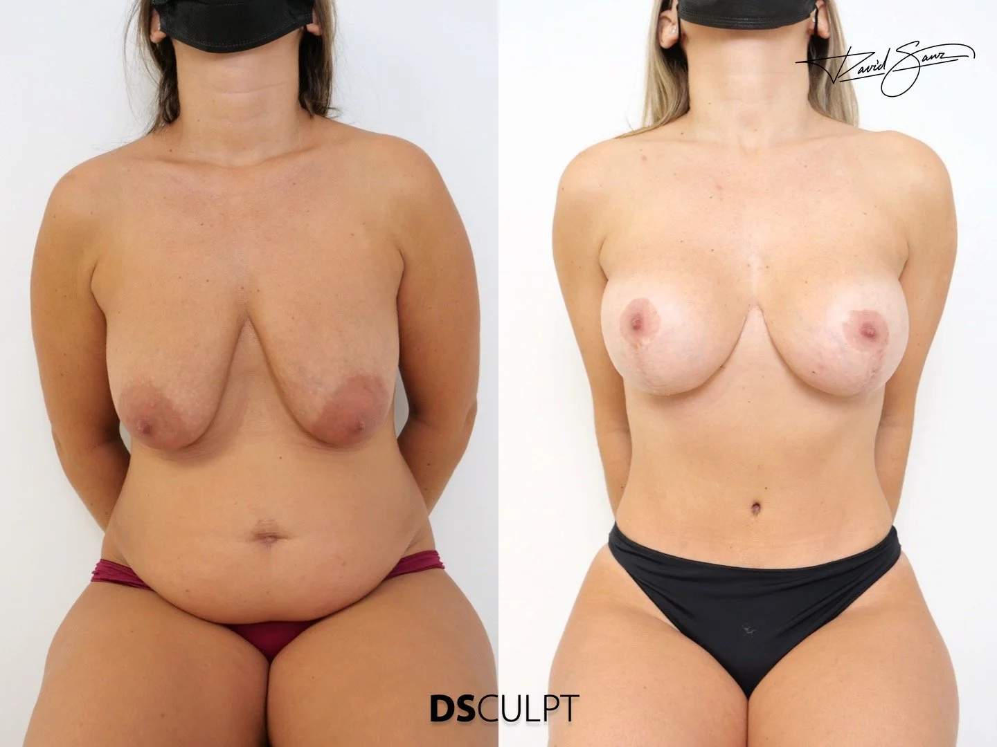cirugia-abdomen-pecho-barcelona-dr-david-sanz-total-body..jpeg