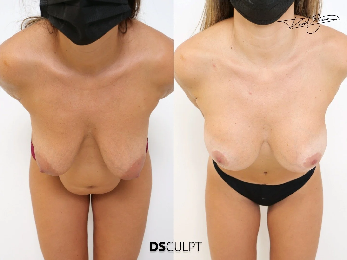 mommy-makeover-resultados-barcelona-dr-david-sanz..jpeg
