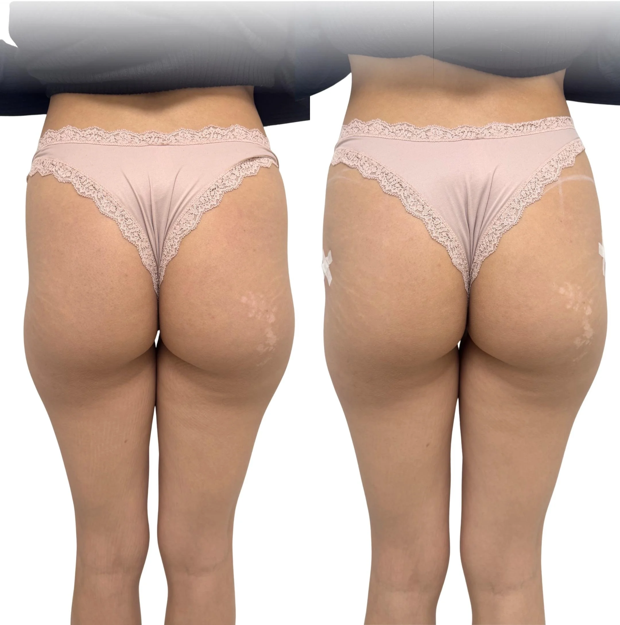 relleno-gluteos-hialuronico-antes-despues-barcelona.png