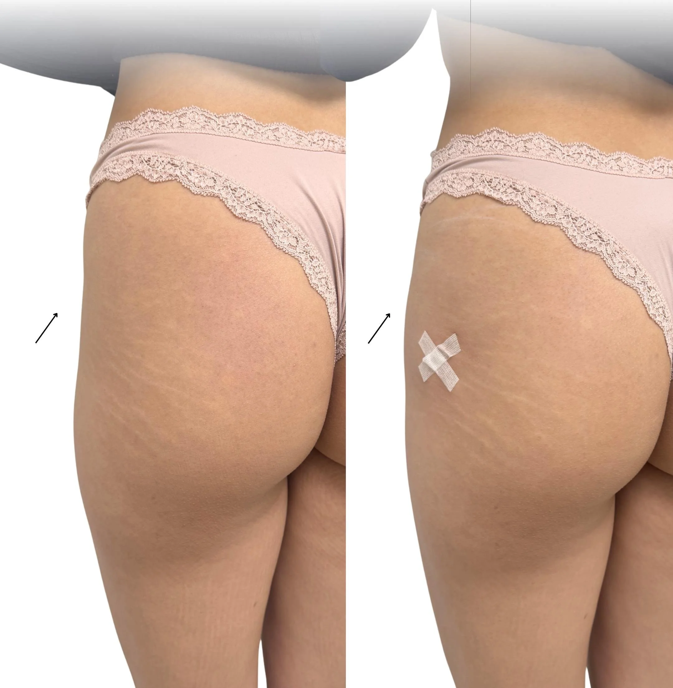 acido-hialuronico-nalgas-resultado-estetico-dsculpt-barcelona.png