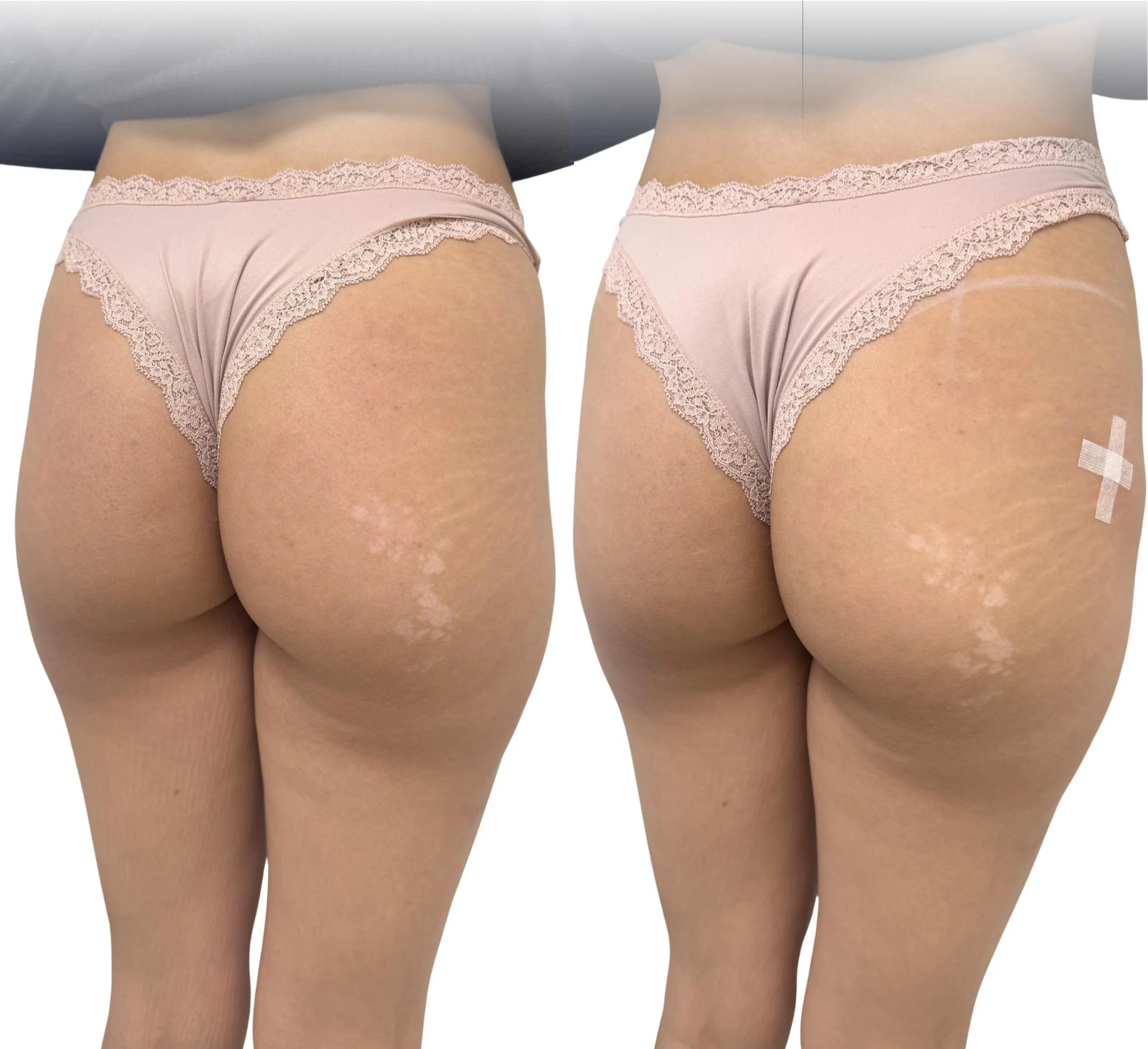 aumento-gluteos-acido-hialuronico-resultado-natural-barcelona.png