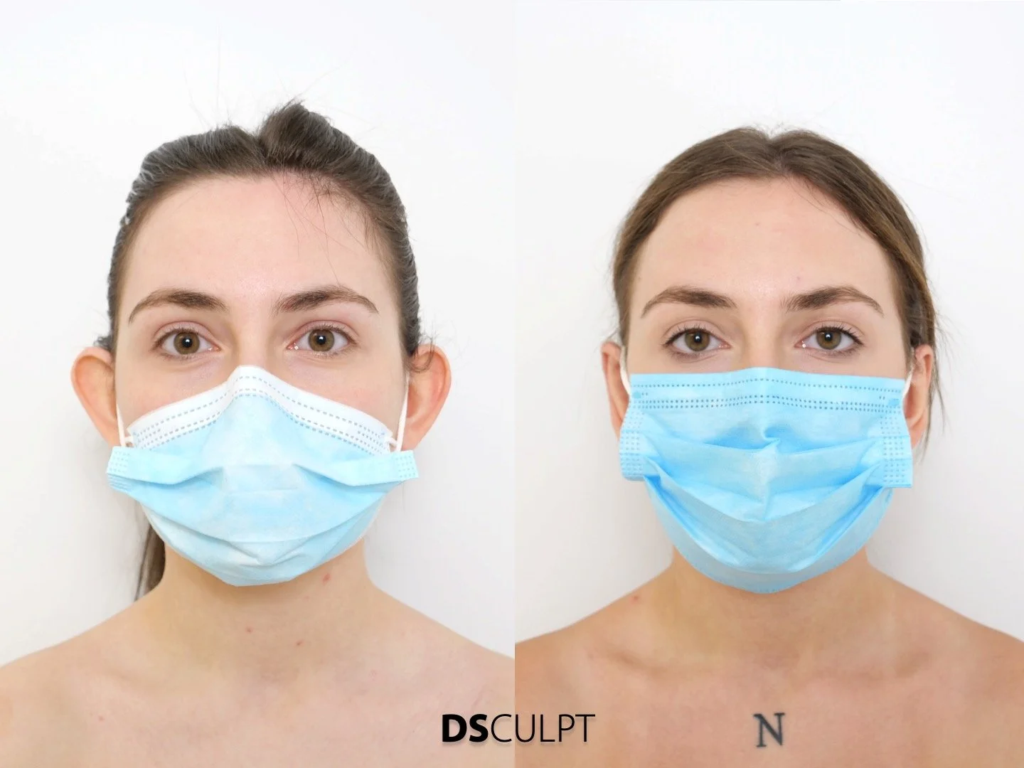Precios de otoplastia y lóbulo rasgado en Barcelona en DSculpt Clinic