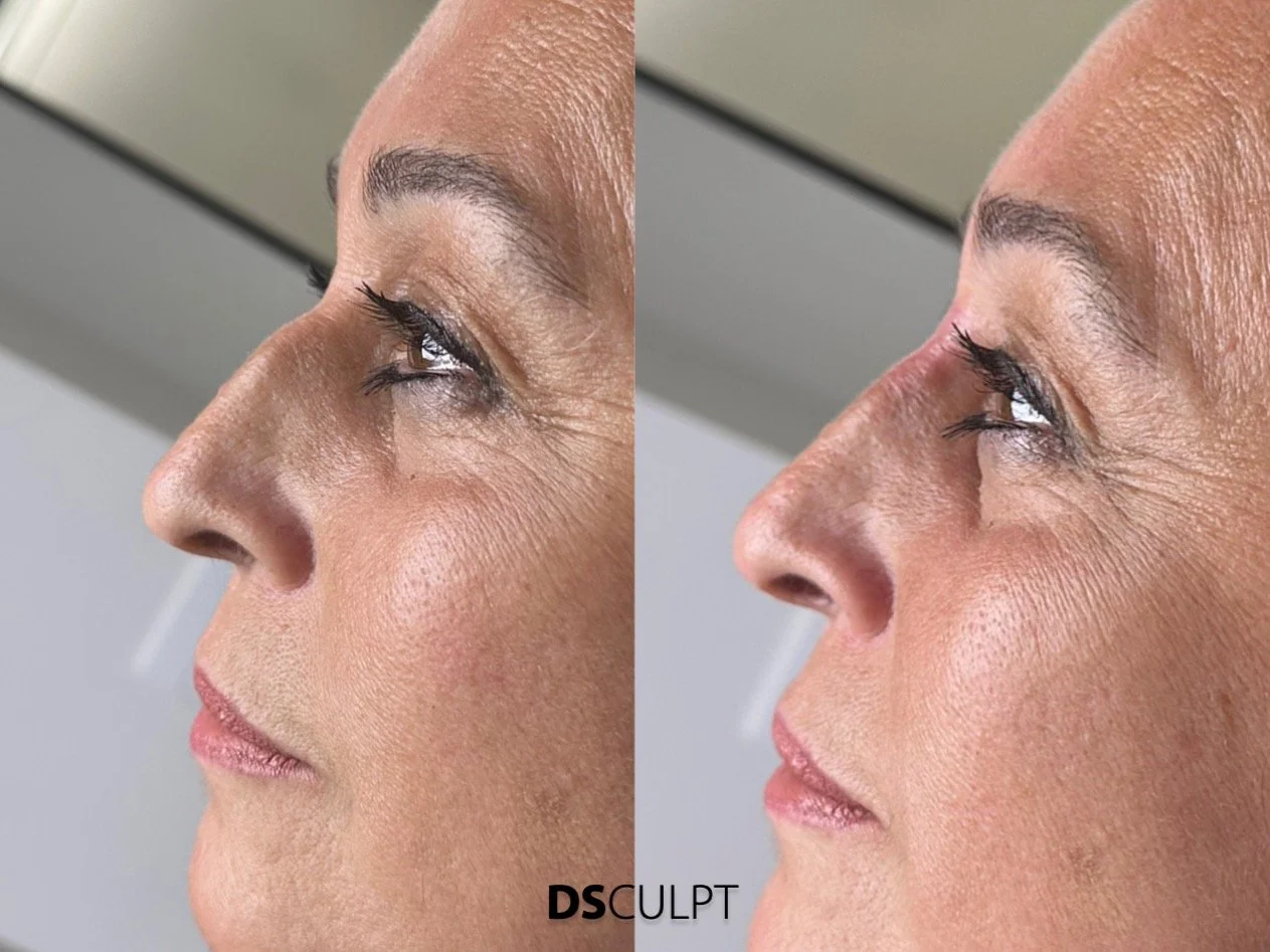 Rinomodelación en Barcelona realizada por el Dr David Sanz especialista en armonización facial