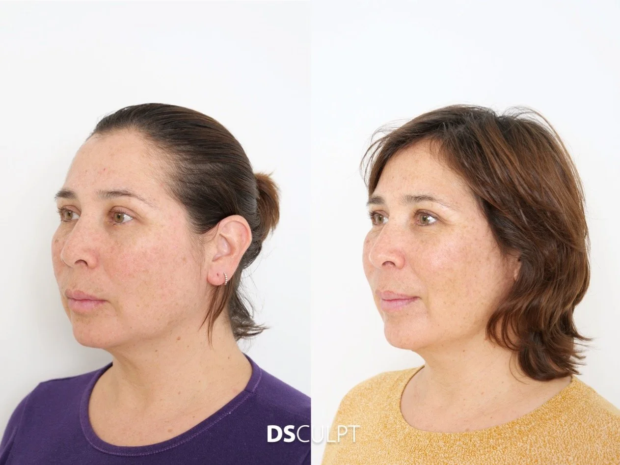 Antes y después del tratamiento Smart DNA en Barcelona para mejorar la calidad de la piel y rejuvenecimiento facial en DSculpt Clinic con el Dr David Sanz