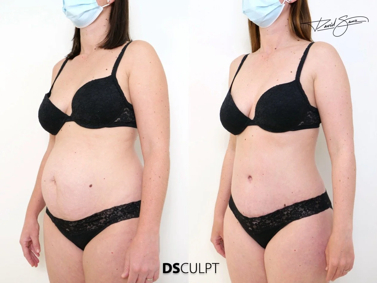 corrección de diástasis de rectos mediante cirugía abdominal en Barcelona