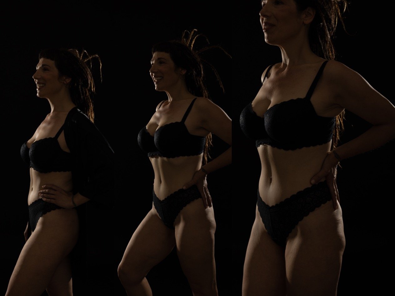 abdomen firme tras cirugía abdominal con resultado natural y proporcionado