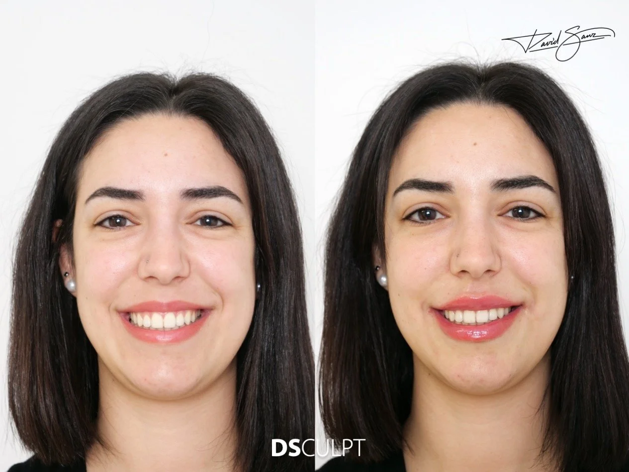 Precio de corrección de sonrisa gingival en Barcelona, resultados naturales