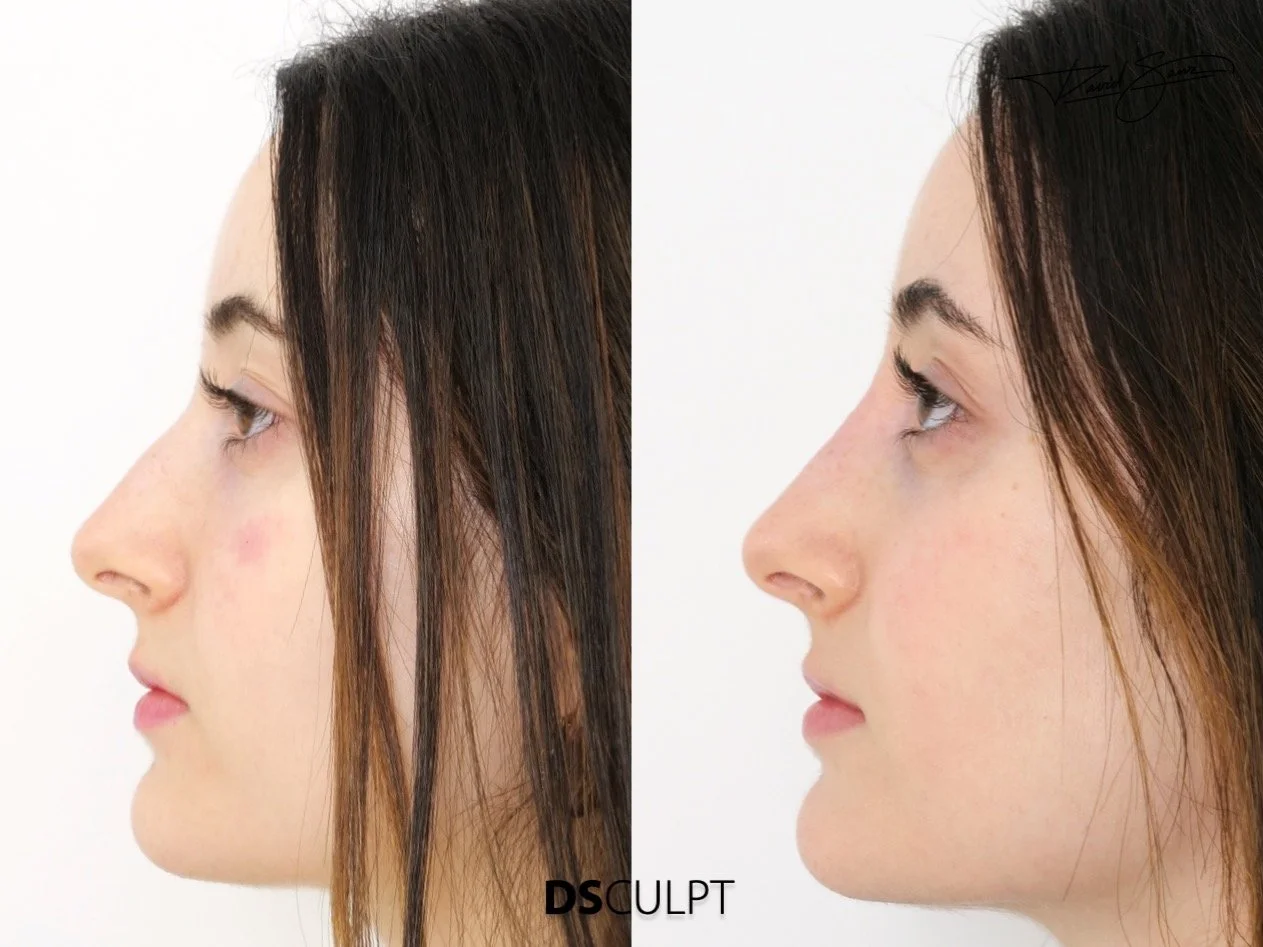 Mejor rinomodelación en Barcelona realizada con ácido hialurónico para mejorar el perfil nasal sin cirugía