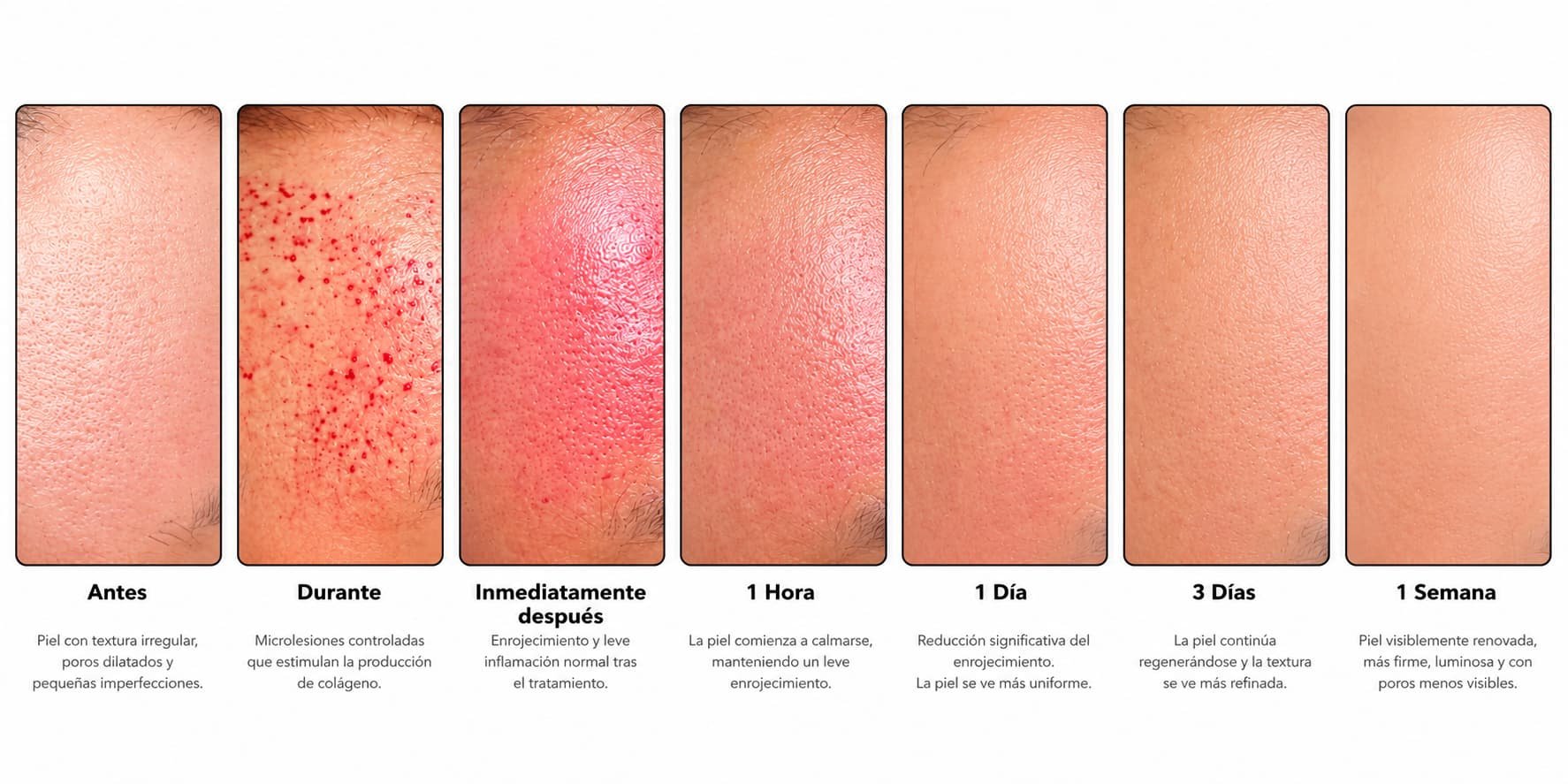 Evolución de la piel después de Morpheus8 para acné y cicatrices en DSculpt Clinic Barcelona