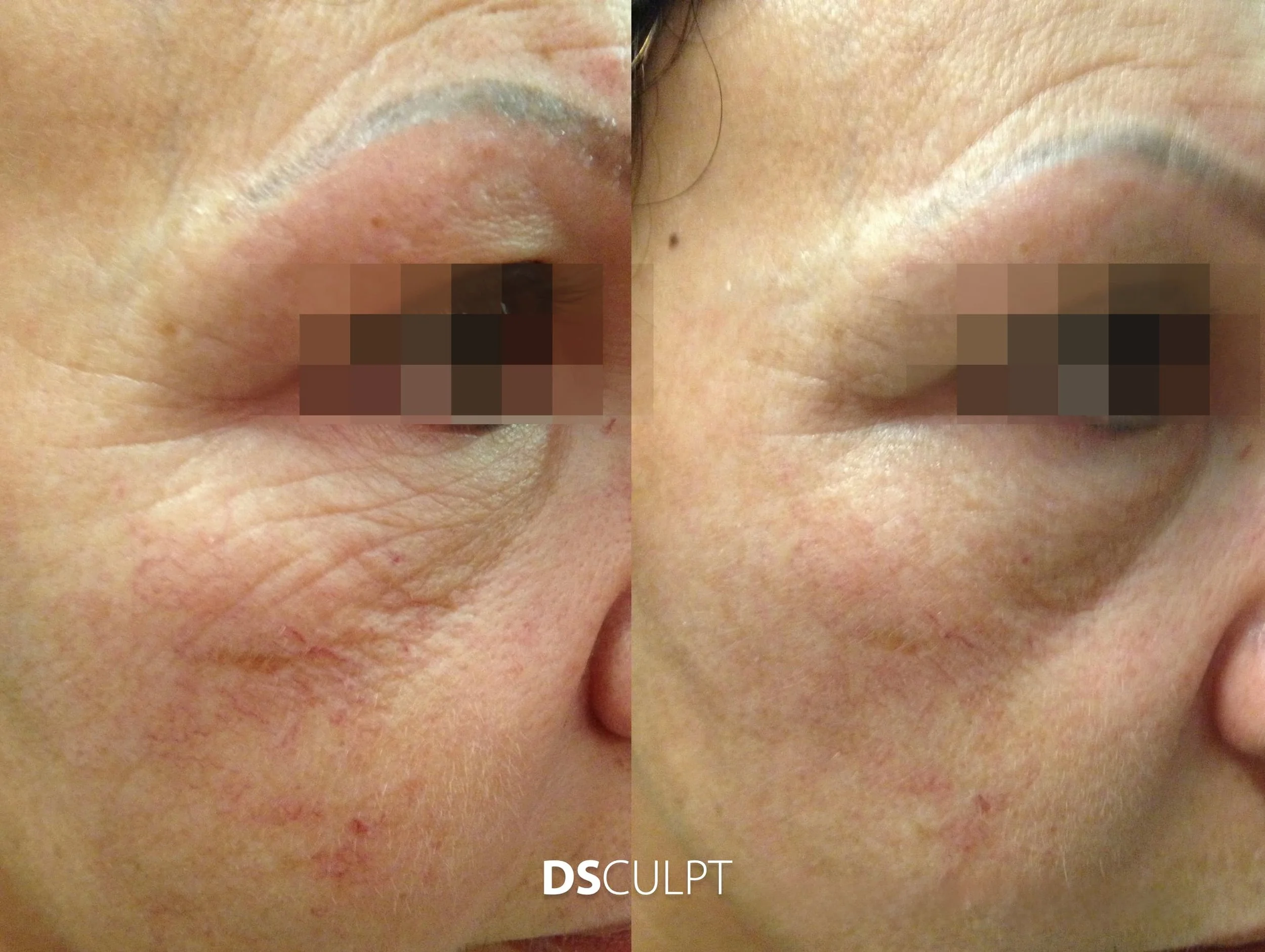 Antes y después de Morpheus periocular en Barcelona para mejorar arrugas finas alrededor de los ojos y calidad de la piel