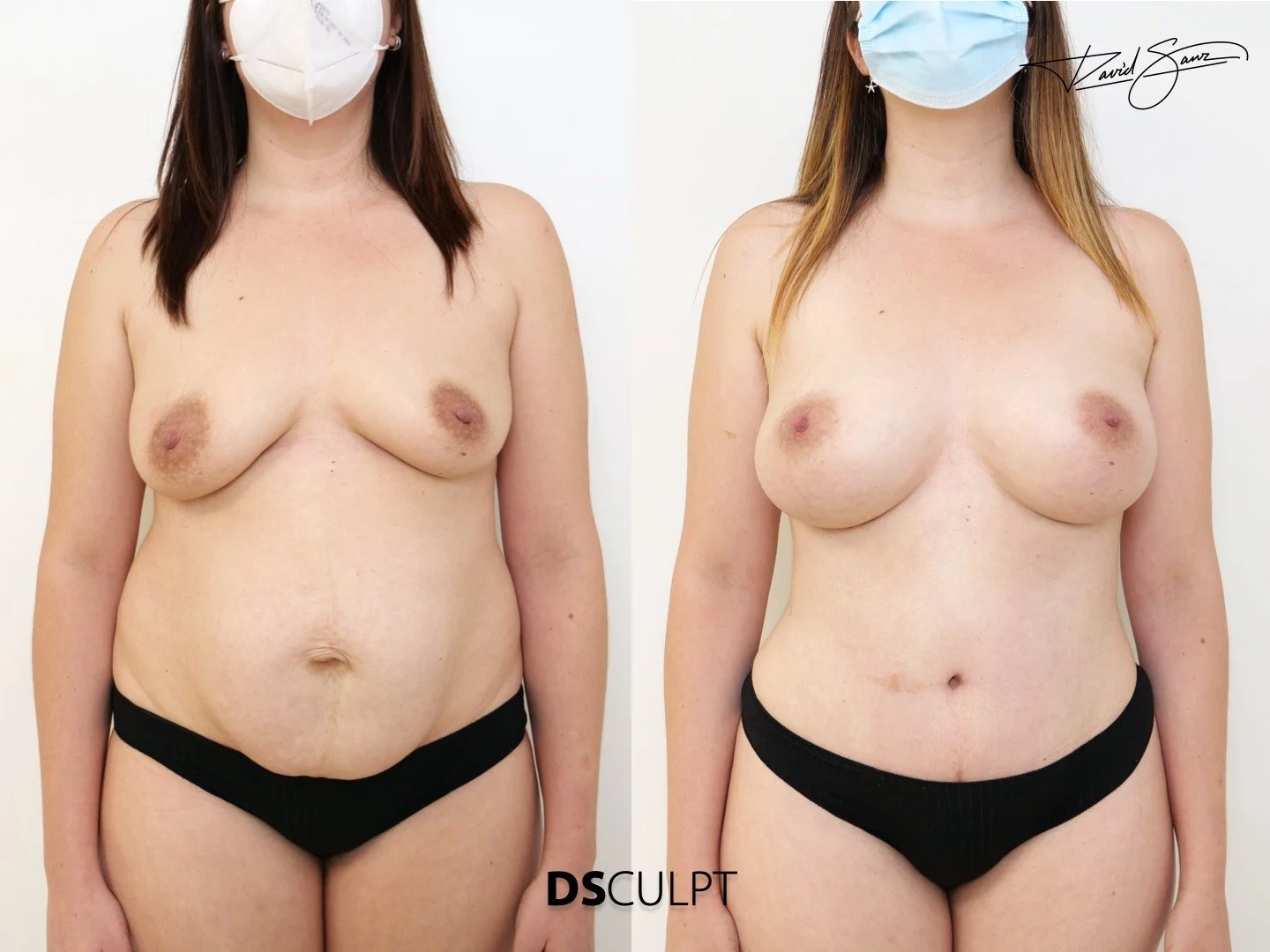 Resultados de Mommy Makeover en Barcelona España realizados por el Dr David Sanz