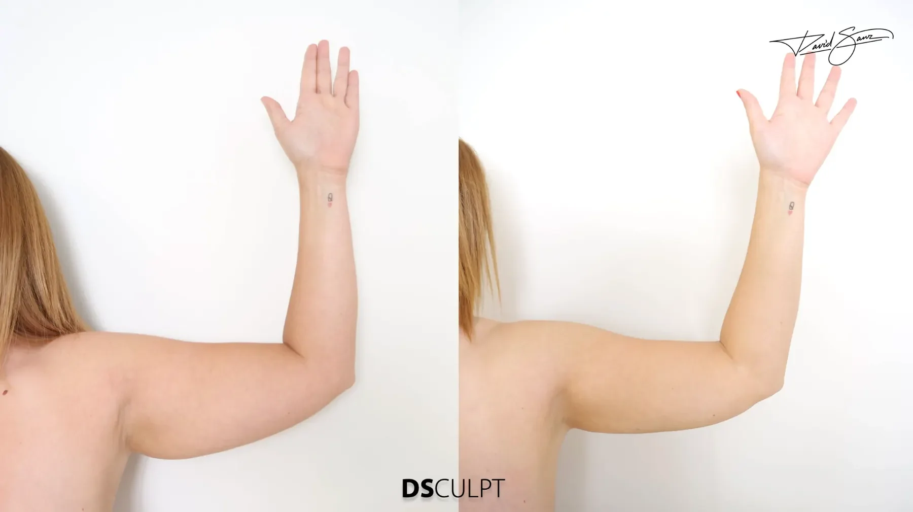 Antes y después de BodyTite en brazos en paciente con flacidez y exceso de tejido