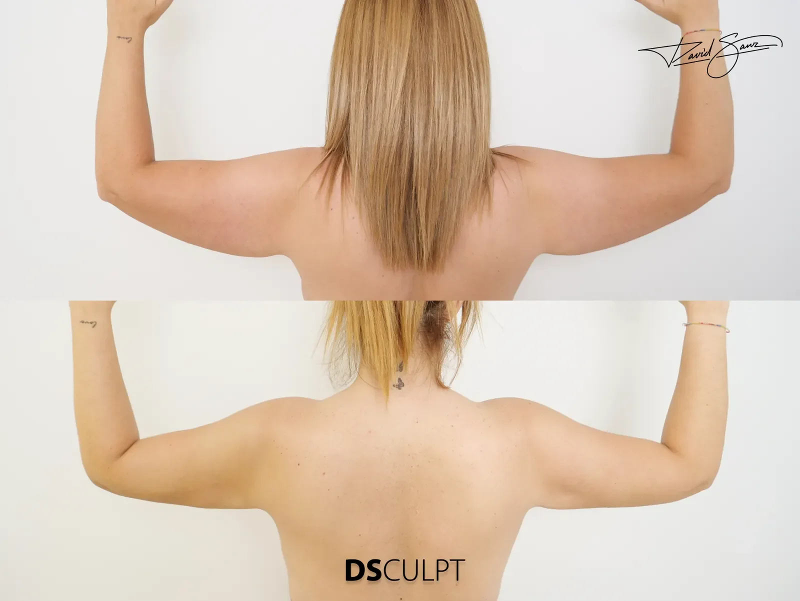 Antes y después de BodyTite para flacidez braquial leve o moderada en un caso clínico real.
