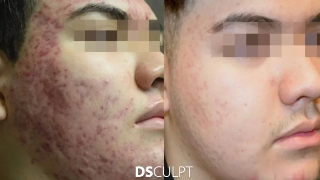 Morpheus combinado con subcisión, peelings y bioestimulación para cicatrices de acné