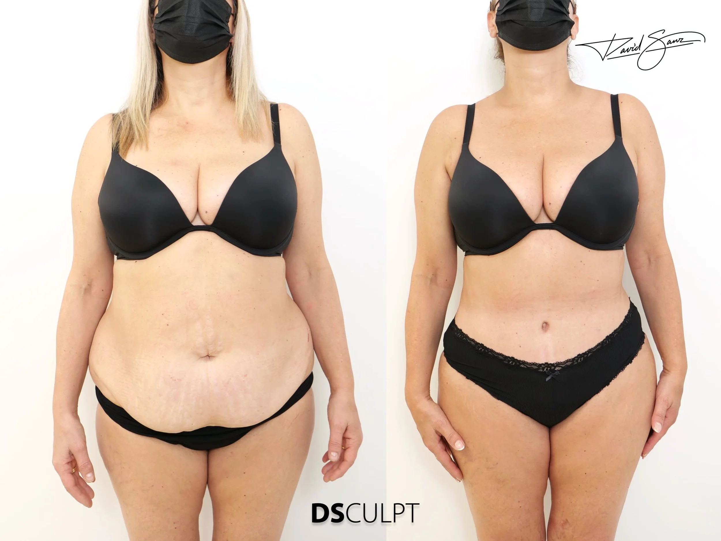 Dermolipectomía abdominal en paciente con faldón grande, imágenes antes y después