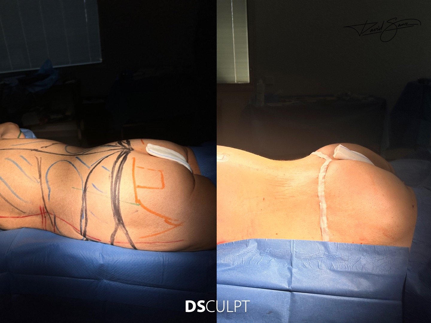 Imagen intraoperatoria de abdominoplastia circular 360 en Barcelona mostrando el plano quirúrgico y la redistribución armónica del contorno corporal