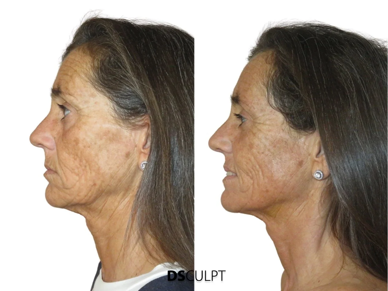 Morpheus facial para signos iniciales de envejecimiento facial