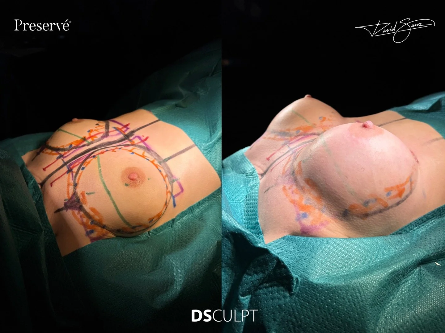 Resultado lateral de aumento de mamas con técnica Preservé en Barcelona, cirugía mamaria mínimamente invasiva con recuperación rápida y forma natural realizada en DSculpt Clinic