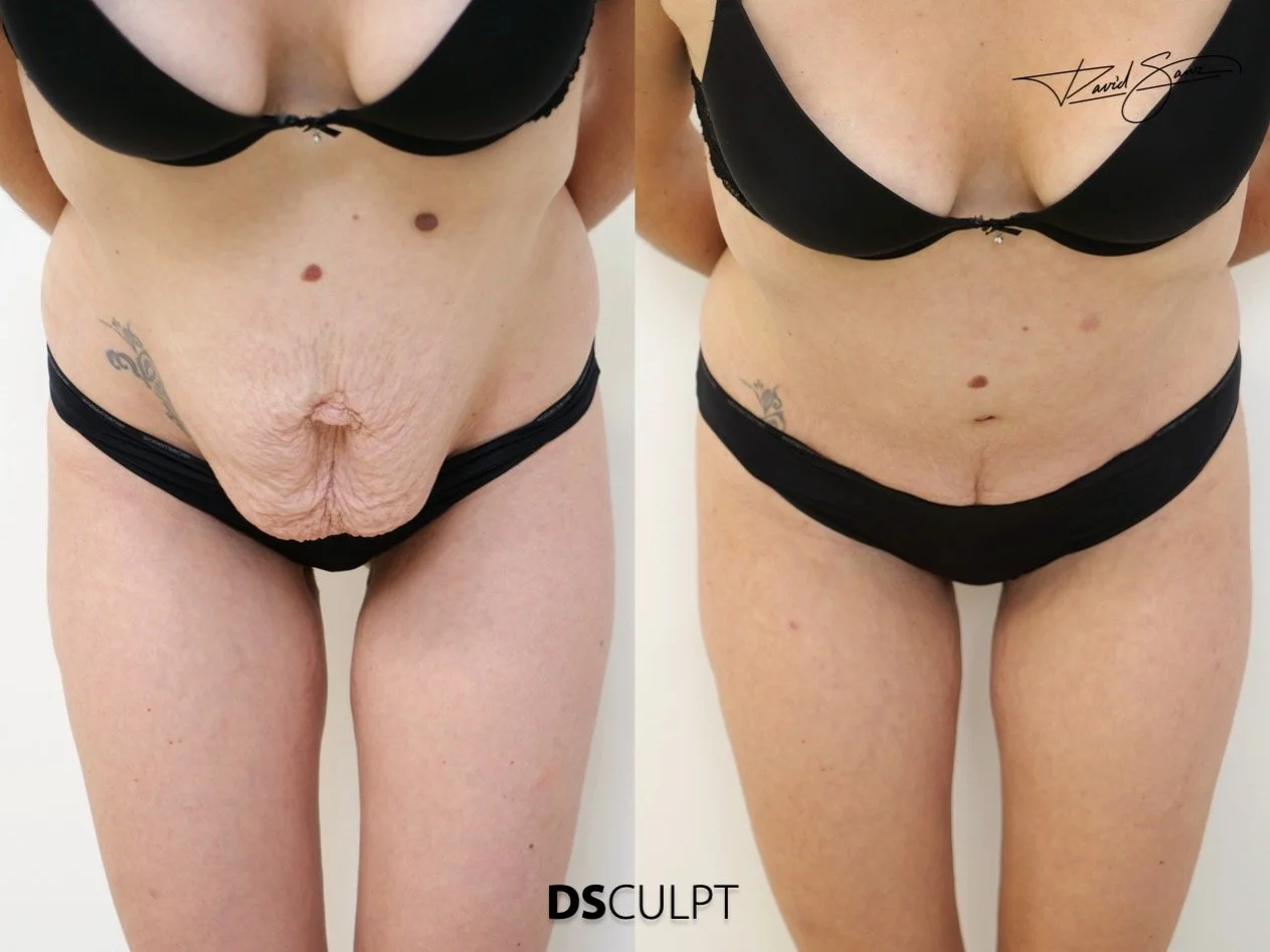 diástasis de rectos asociada a hernia abdominal