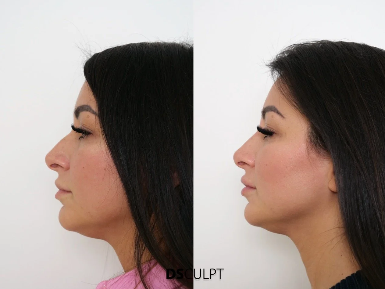 Clínica especializada en rinomodelación en Barcelona DSculpt Clinic tratamiento nasal sin cirugía
