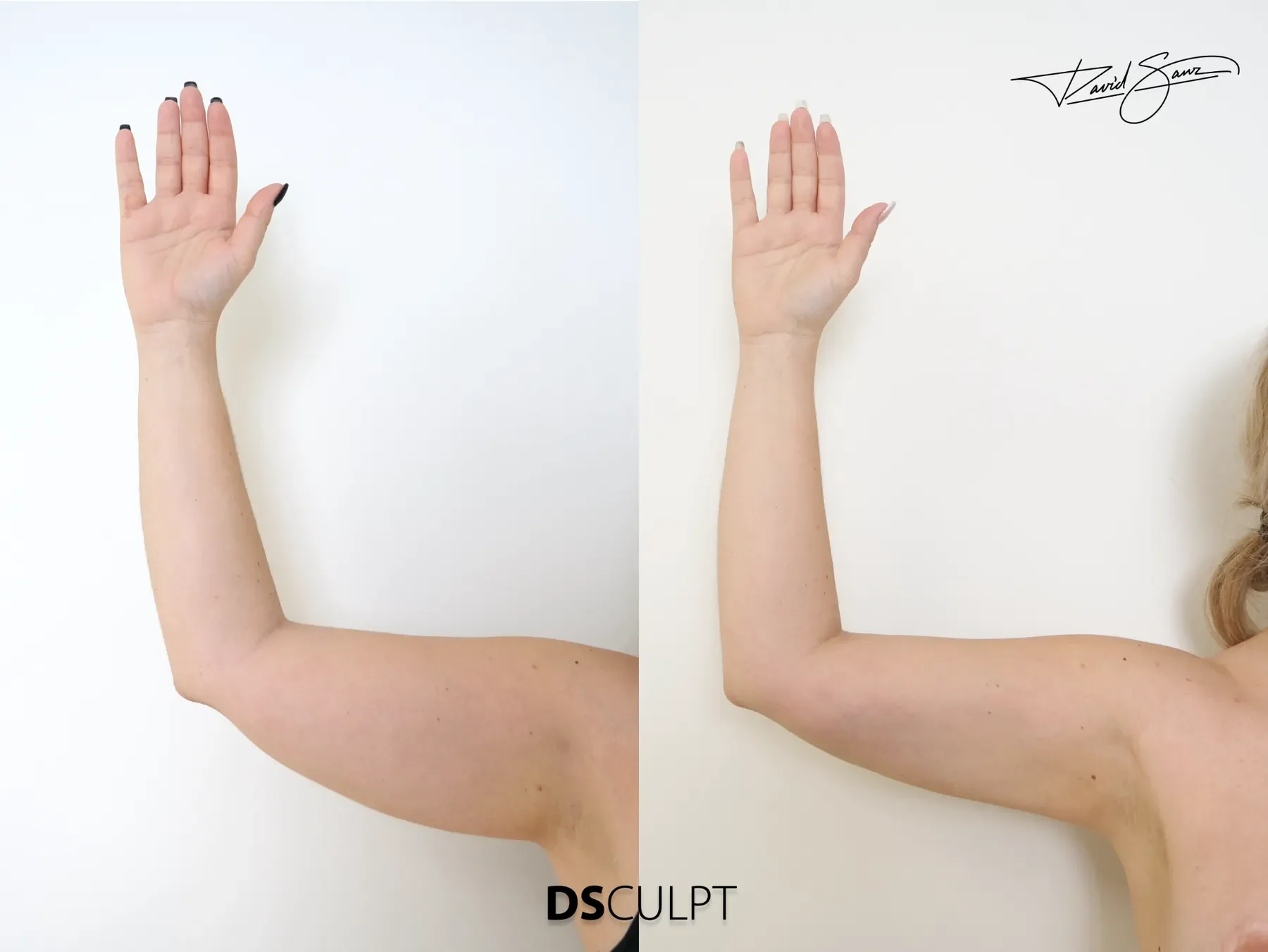 Antes y después de BodyTite para tratar flacidez leve o moderada de los brazos