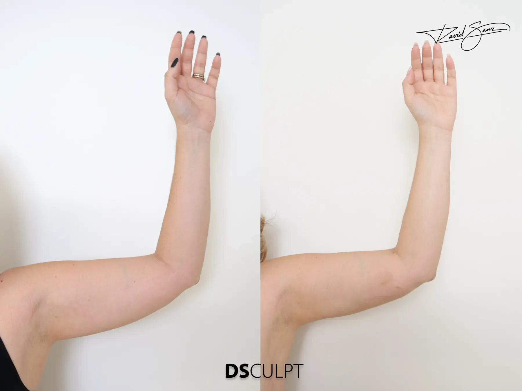 Comparativa antes y después de tratamiento BodyTite para remodelación de brazos