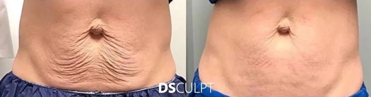 Morpheus frente a abdominoplastia para exceso de piel y flacidez abdominal
