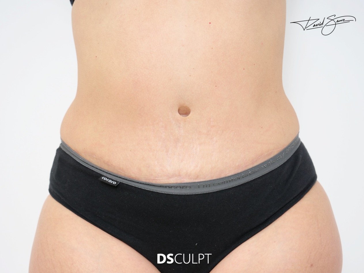 resultado de cicatriz abdominal tras abdominoplastia con buena evolución y aspecto fino