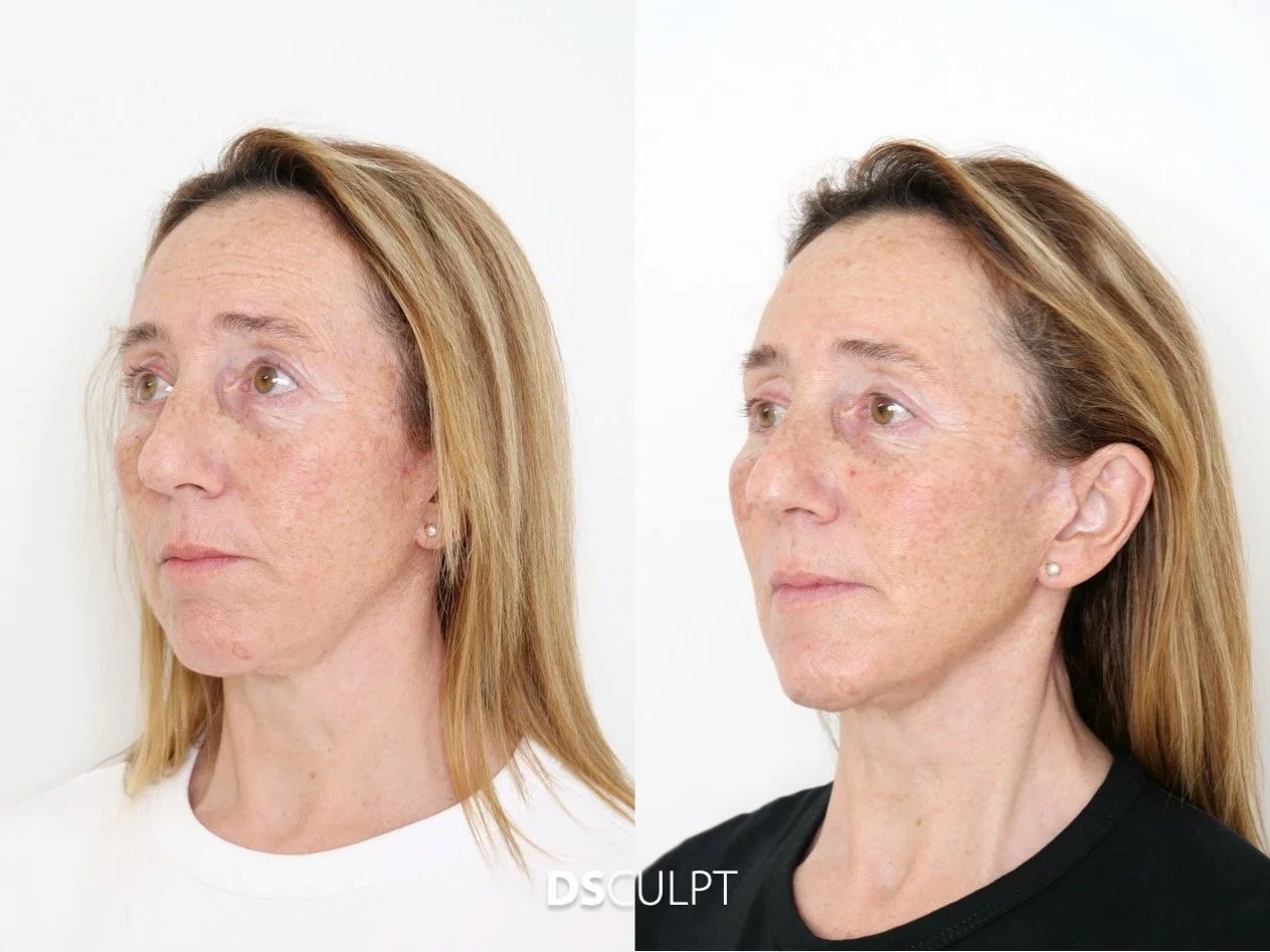 Antes y después de rejuvenecimiento facial con Smart DNA en Barcelona con mejora del tono y calidad de la piel