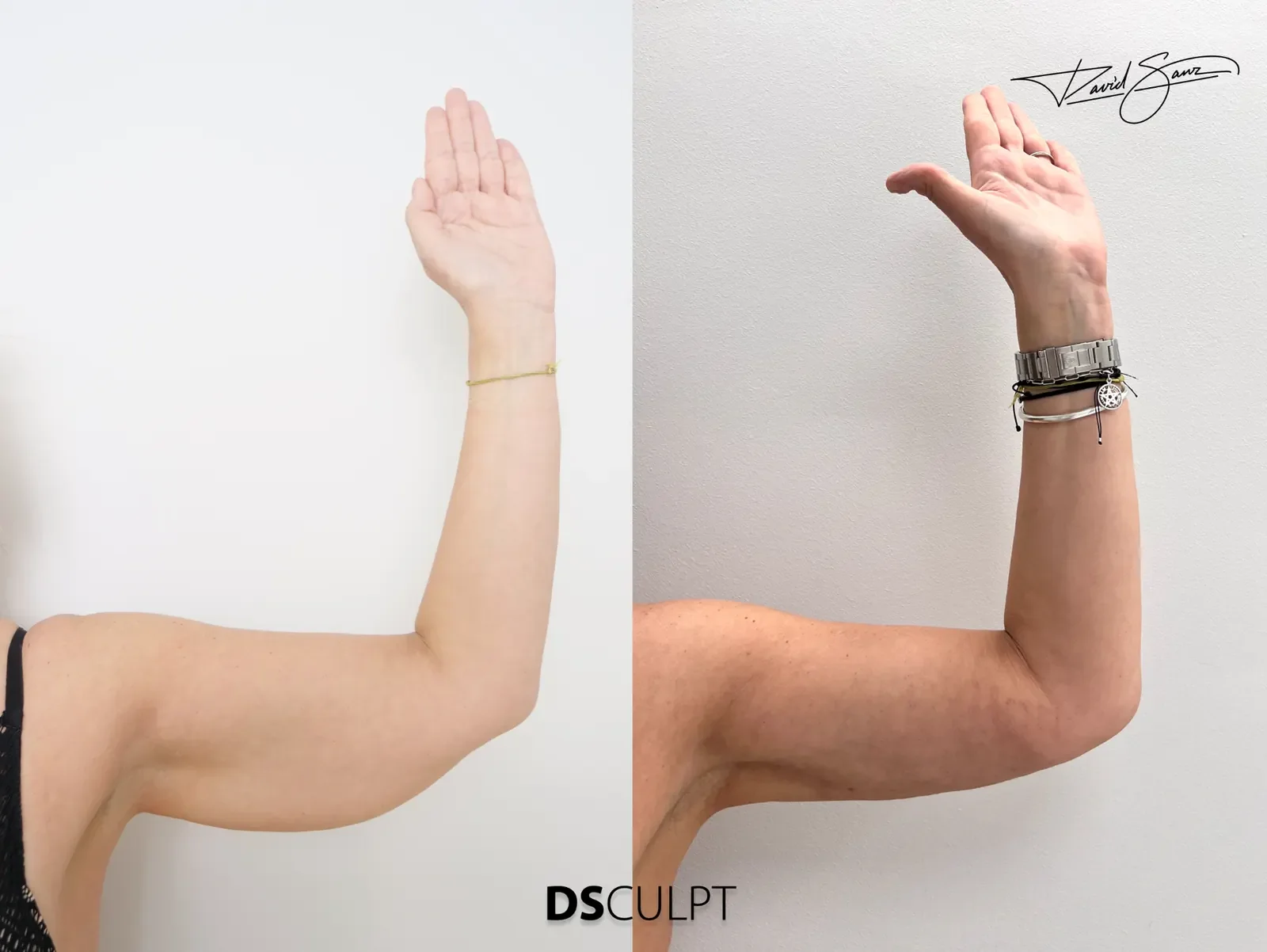 Antes y después de BodyTite para tratar piel flácida de los brazos sin la cicatriz larga de una braquioplastia