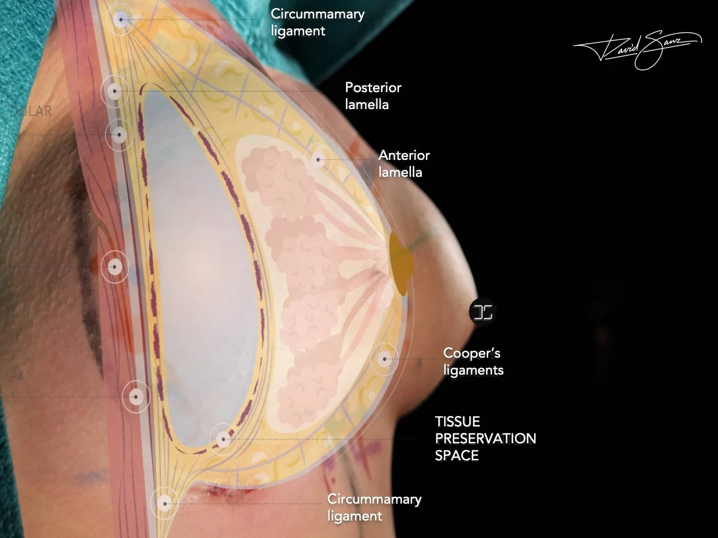Imagen intraoperatoria de la técnica Preservé para aumento de pecho en Barcelona, preservación de ligamentos mamarios y mínima agresión quirúrgica en cirugía mamaria avanzada.